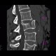 Fracture of lumbar vertebra, comminuted, burst fracture: CT - Computed tomography